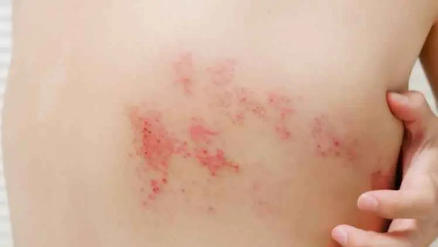 नागीण कशामुळे होते? | Nagin Disease Causes in Marathi