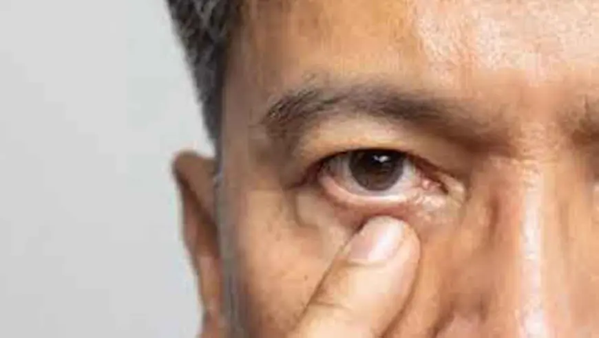 मोतीबिंदू कशामुळे होतो? – कारण, लक्षणे व प्रतिबंध